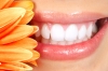 Teeth Whitening (Bleaching)