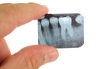 Fillings (Restorative Dentistry)